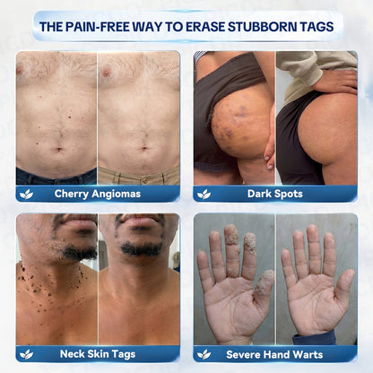 𝐏𝐡𝐚𝐫𝐦𝐚𝐜𝐢𝐬𝐭 𝐑𝐞𝐜𝐨𝐦𝐦𝐞𝐧𝐝𝐞𝐝 ✅𝐏𝐢𝐜𝐝𝐨® 7-𝐃𝐚𝐲 𝐒𝐤𝐢𝐧 𝐓𝐚𝐠 & 𝐒𝐩𝐨𝐭 𝐄𝐫𝐚𝐬𝐞𝐫 𝐂𝐫𝐞𝐚𝐦 🧴(Zero Pain, Zero 𝐒𝐜𝐚𝐫𝐬 Formula) 💪
