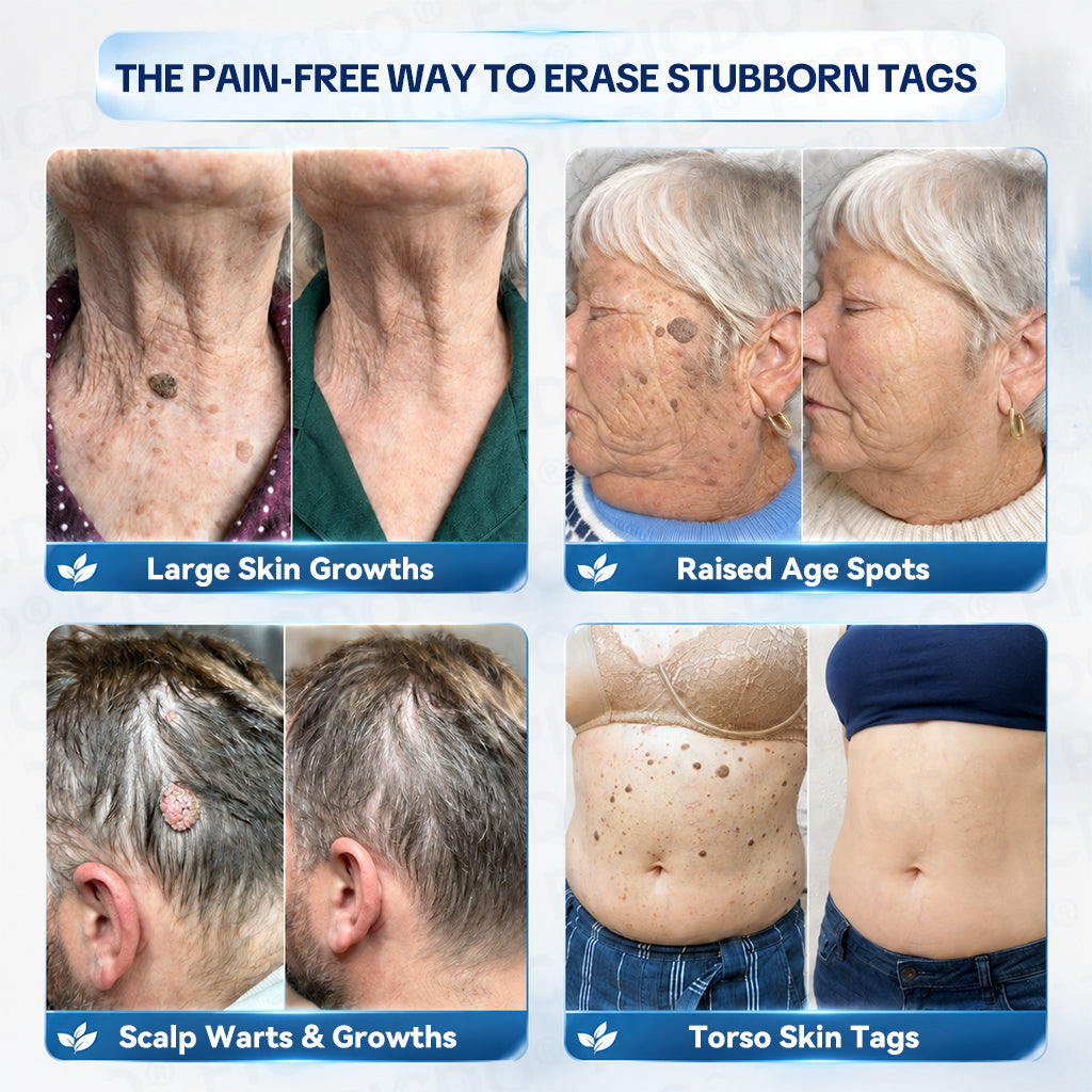 𝐏𝐡𝐚𝐫𝐦𝐚𝐜𝐢𝐬𝐭 𝐑𝐞𝐜𝐨𝐦𝐦𝐞𝐧𝐝𝐞𝐝 ✅𝐏𝐢𝐜𝐝𝐨® 7-𝐃𝐚𝐲 𝐒𝐤𝐢𝐧 𝐓𝐚𝐠 & 𝐒𝐩𝐨𝐭 𝐄𝐫𝐚𝐬𝐞𝐫 𝐂𝐫𝐞𝐚𝐦 🧴(Zero Pain, Zero 𝐒𝐜𝐚𝐫𝐬 Formula) 💪