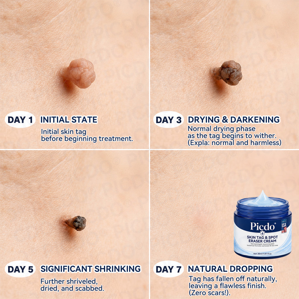 𝐏𝐡𝐚𝐫𝐦𝐚𝐜𝐢𝐬𝐭 𝐑𝐞𝐜𝐨𝐦𝐦𝐞𝐧𝐝𝐞𝐝 ✅𝐏𝐢𝐜𝐝𝐨® 7-𝐃𝐚𝐲 𝐒𝐤𝐢𝐧 𝐓𝐚𝐠 & 𝐒𝐩𝐨𝐭 𝐄𝐫𝐚𝐬𝐞𝐫 𝐂𝐫𝐞𝐚𝐦 🧴(Zero Pain, Zero 𝐒𝐜𝐚𝐫𝐬 Formula) 💪